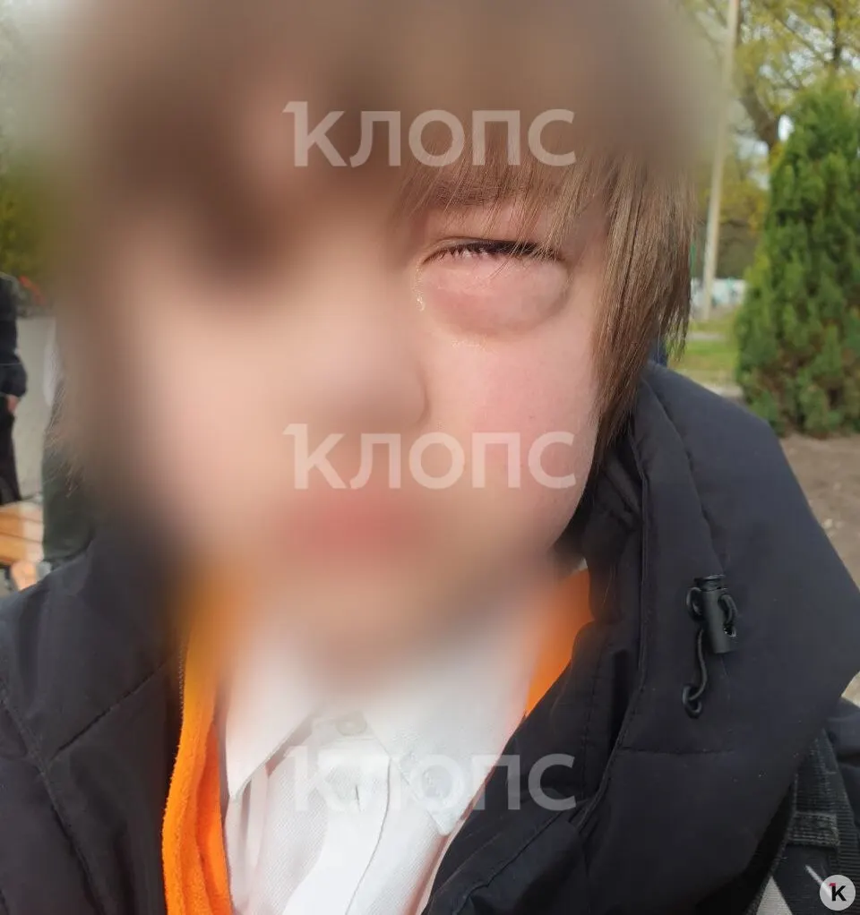 Мать ребёнка рассказала, что инцидент произошёл 23 апреля: после удара мальчика срочно госпитализировали с переломом глазницы, операцию провели на следующий день. По словам матери, урок при этом продолжался.